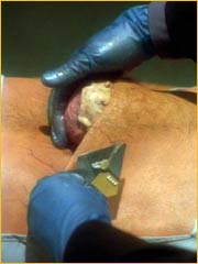 Poche abdominale